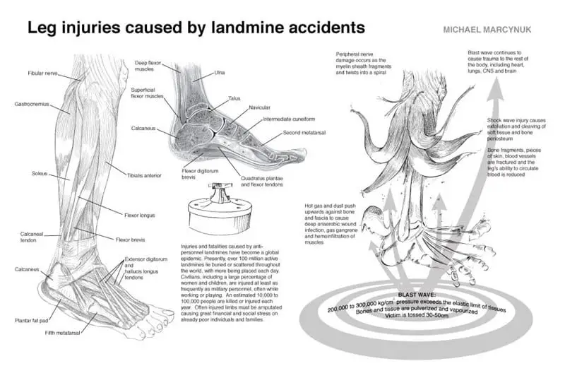 Land Mine Injuries The Good Human what-is-polysorbate-80-what-is-it-used-for