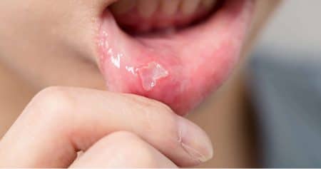 treating-canker-sores