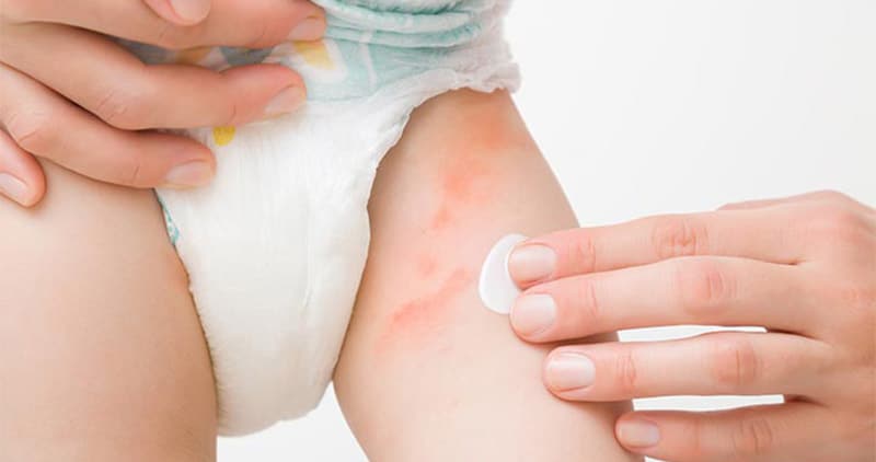 What Is A Diaper Rash?