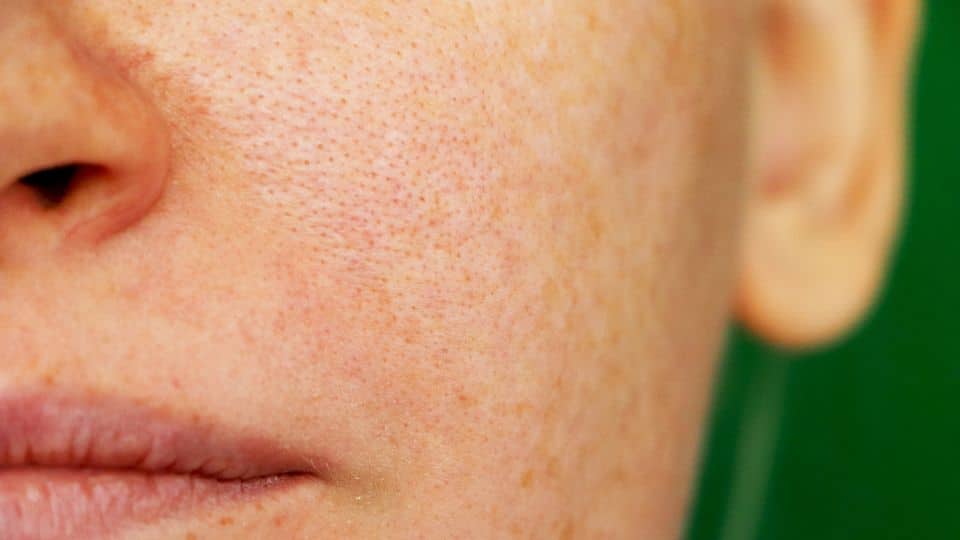 Open pores treatment