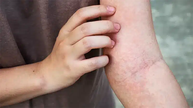 Person has Skin irritation