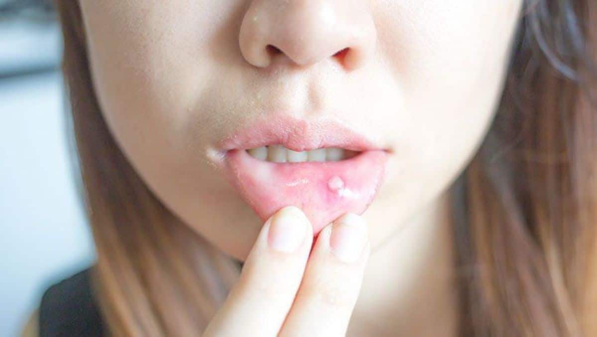 A girl holding down her lower lip showing a canker sore.
